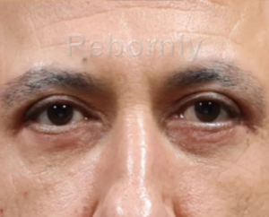 Regard du patient après sa blépharoplastie au niveau des paupières inférieures