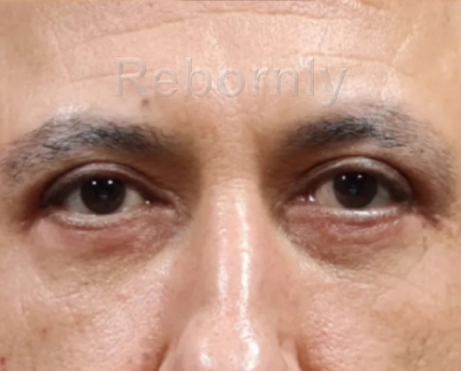 Photo 3 blépharoplastie après