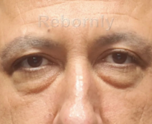 Regard de l'homme avant sa blépharoplastie au niveau des paupières inférieures en Turquie.