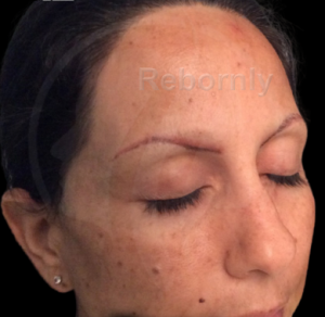 présentation greffe de sourcils patient 2 avant