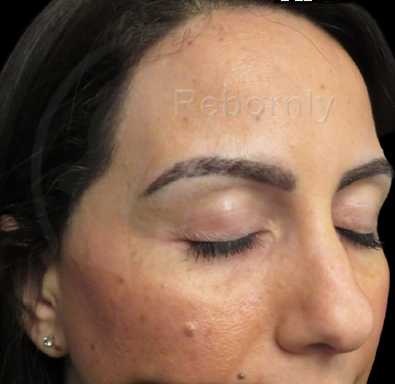 présentation greffe de sourcils patient 2 après