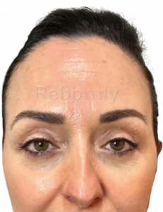 Regard de la femme 2 après sa blépharoplastie au niveau de la paupière inférieure en Turquie.