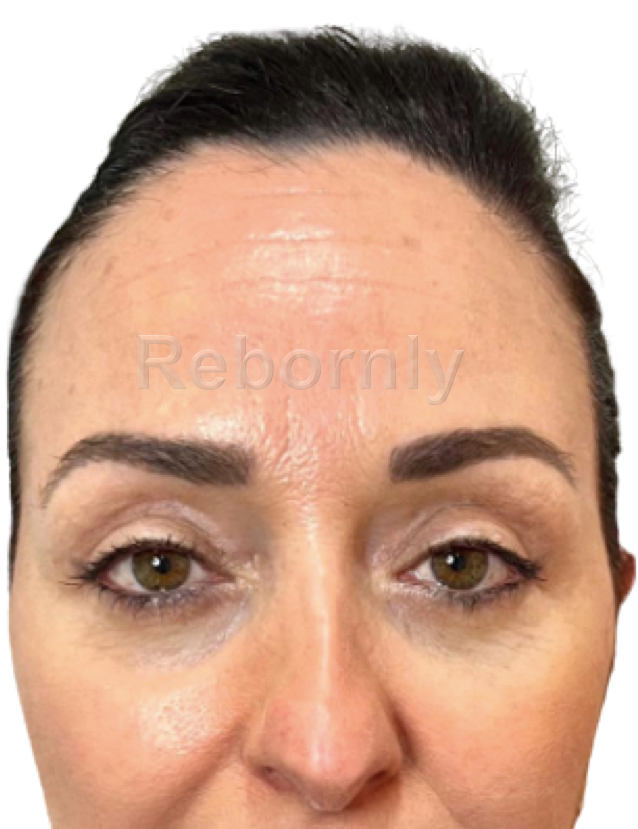 Photo 2 blépharoplastie après