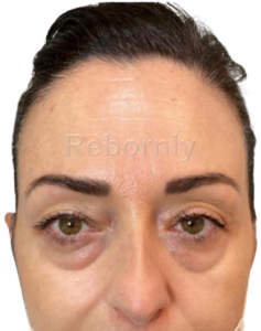 Regard de la femme 2 avant sa blépharoplastie au niveau de la paupière inférieure en Turquie.