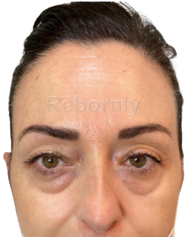 Photo 2 blépharoplastie avant