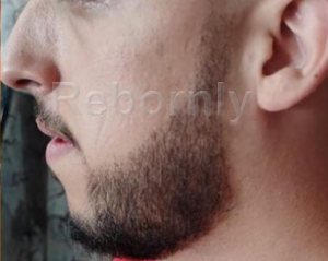 Implant de barbe en Turquie avant l'intervention, greffe de barbe avant l'intervention en Turquie