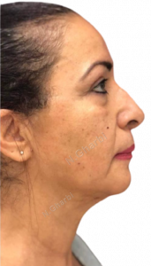 Après lifting 1