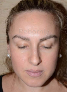 Patiente 1 près la greffe de sourcils