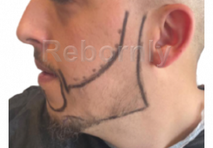 Implant de barbe en Turquie avant l'intervention, greffe de barbe avant l'intervention en Turquie