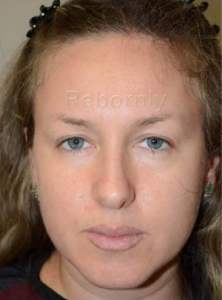Patiente 1 avant la greffe de sourcils