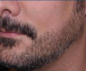 Implant de barbe en Turquie après l'intervention, greffe de barbe après l'intervention en Turquie