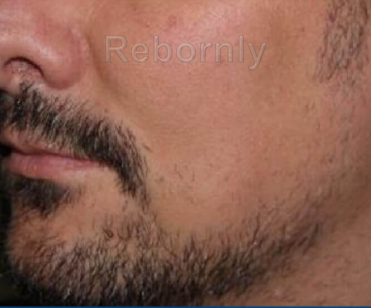 Photo patient 1 avant greffe de barbe