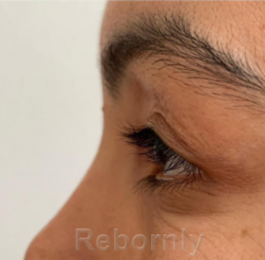 Photo d'une femme 1 après sa blépharoplastie de la paupière supérieure en Turquie