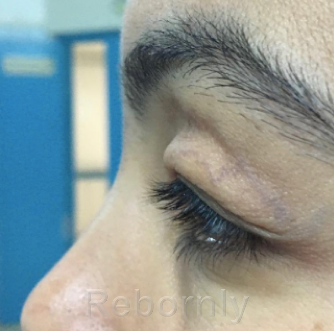 Photo 1 blépharoplastie avant