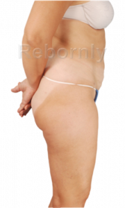 Après Liposuccion