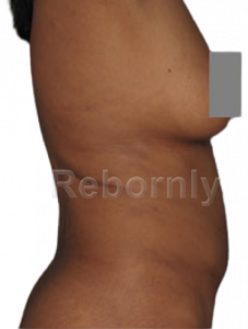 Après liposuccion 1