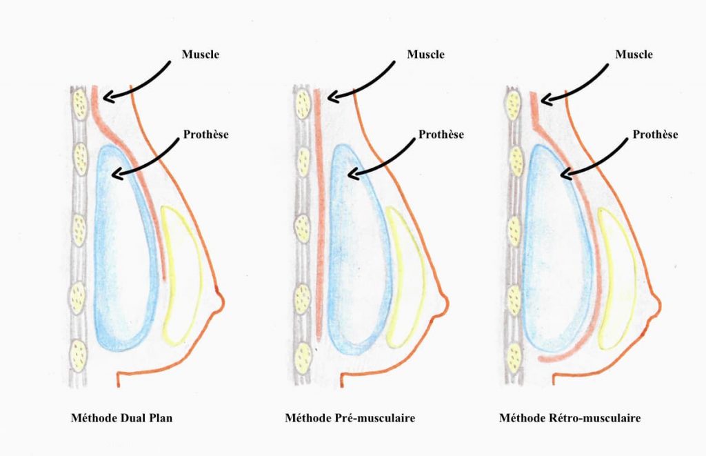 Différentes positions des prothèses sous le muscle
