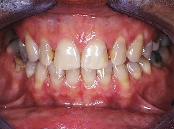 patient 1: Sans facettes dentaires