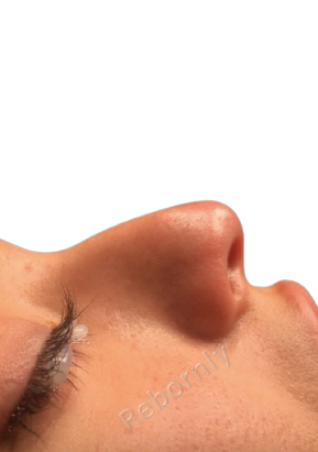 Rhinoplastie patient 3 avant