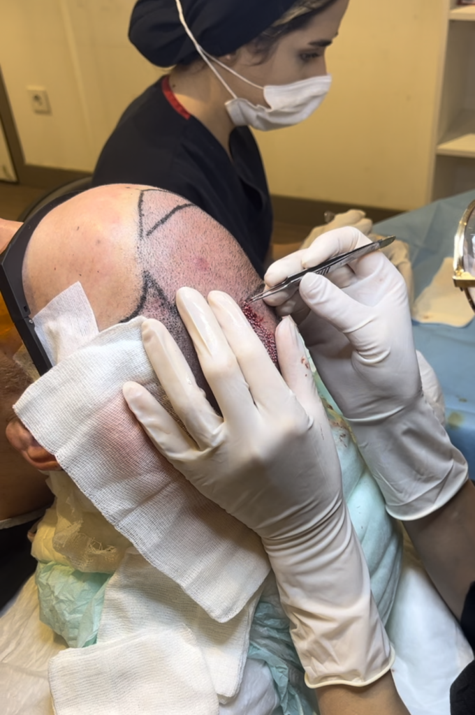 Implantation avec la technique Saphir