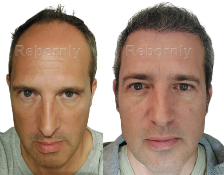 Matthieu greffe de cheveux avant et après