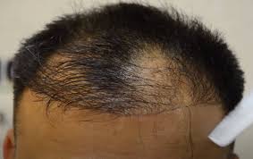 Repousse hétérogène des cheveux après une greffe ratée