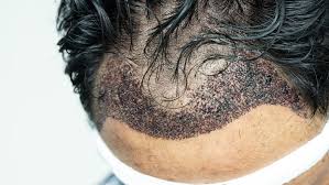 Infection à la suite d’une greffe de cheveux 