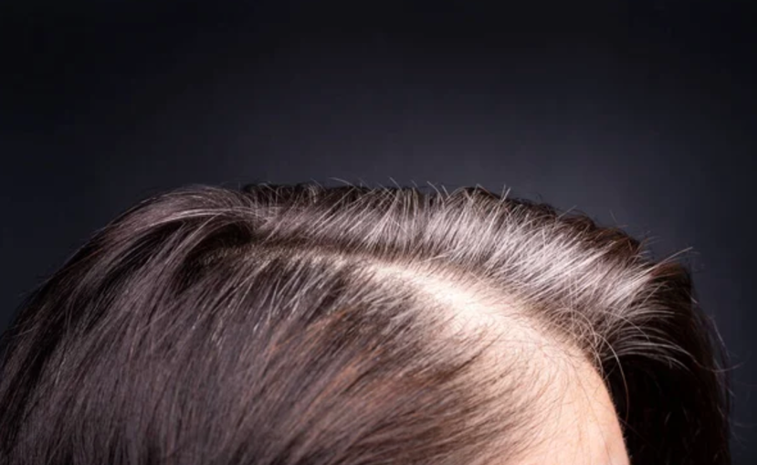 Cuir chevelu féminin au taux de chute anormal nécessitant une greffe de cheveux