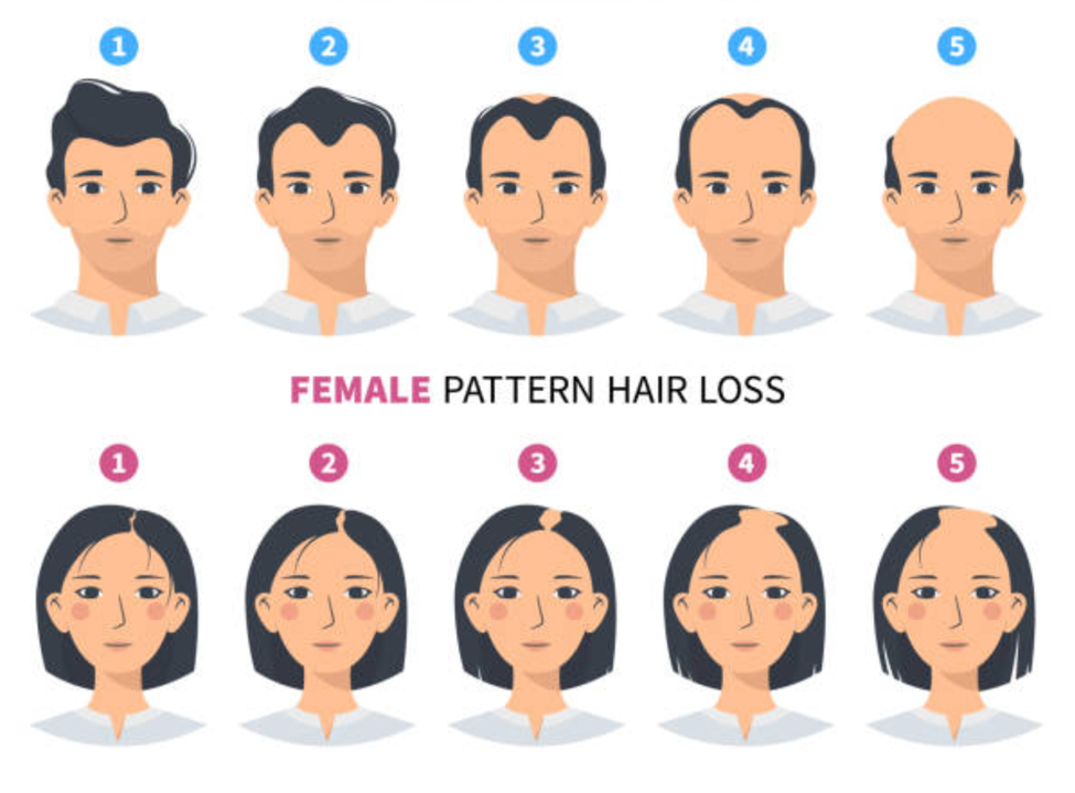 Comparaison entre le schéma de perte de cheveux masculin et féminin