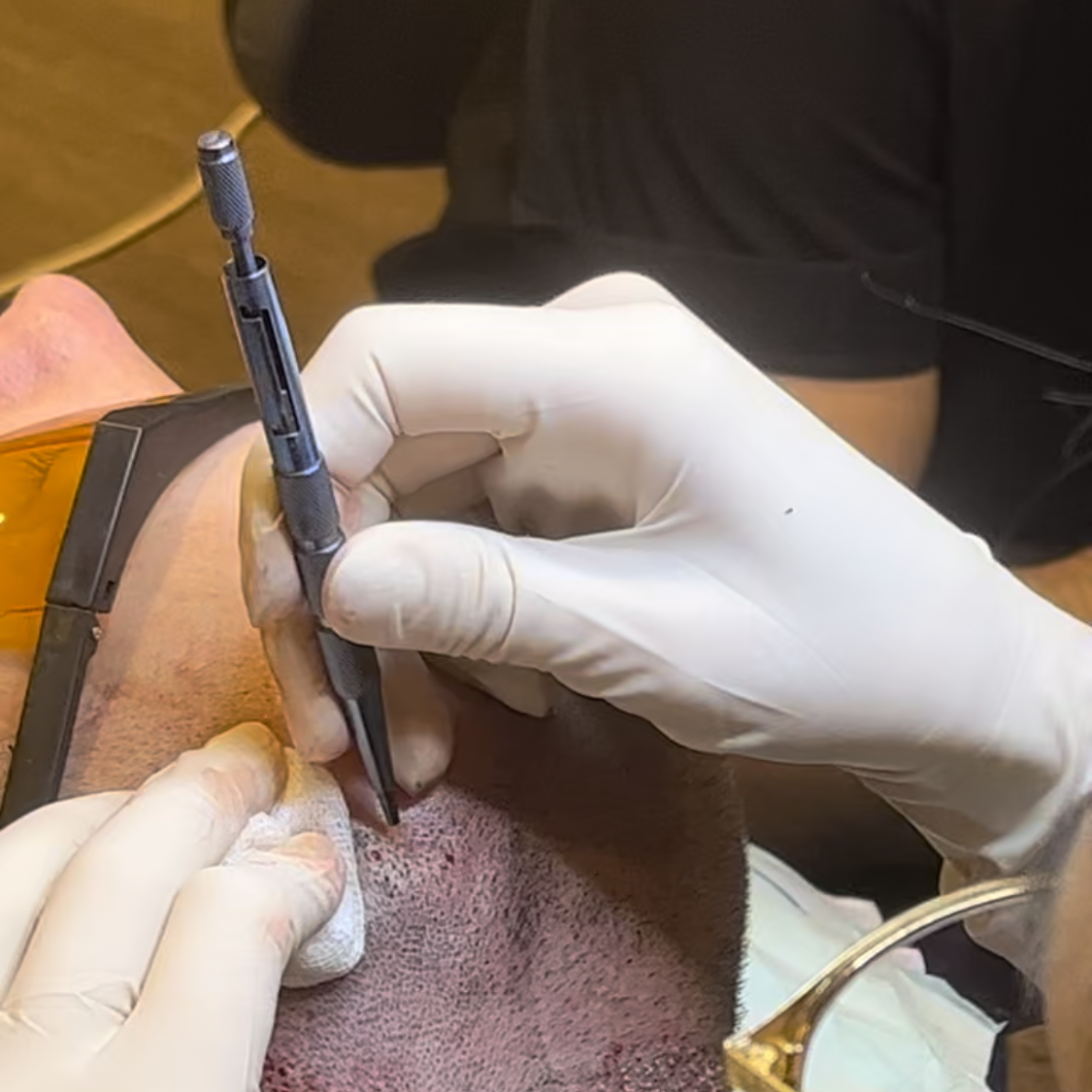 Technique de greffe Saphir incision
