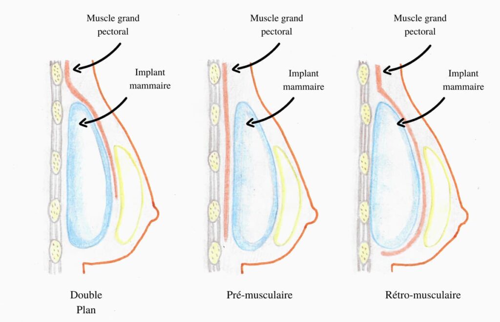 Positions des implants mammaires : Dual plan, devant le muscle pectoral, derrière le muscle pectoral