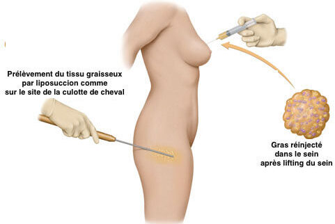Technique de lipofilling mammaire dans le cadre d'une augmentation mammaire composite