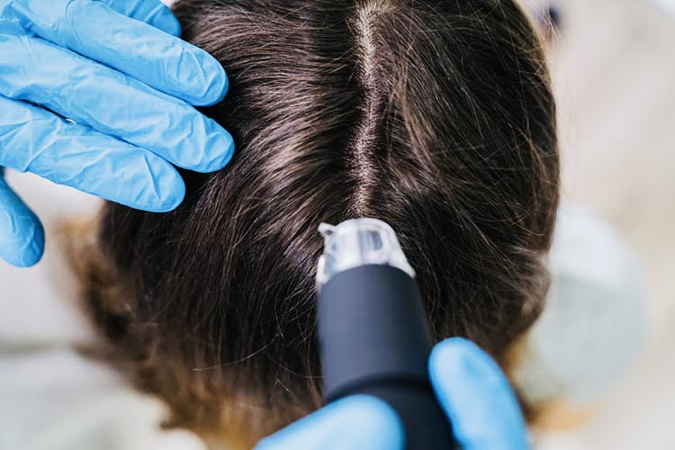 Analyse du cuir chevelu au trichoscope