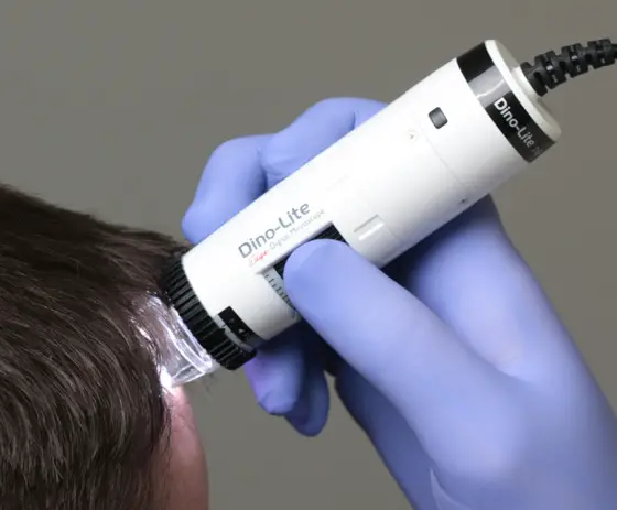 Analyse du cuir chevelu au trichoscope